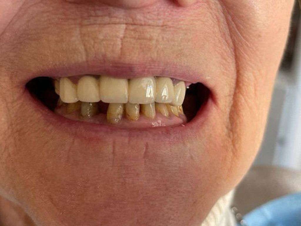 До имплантации 5