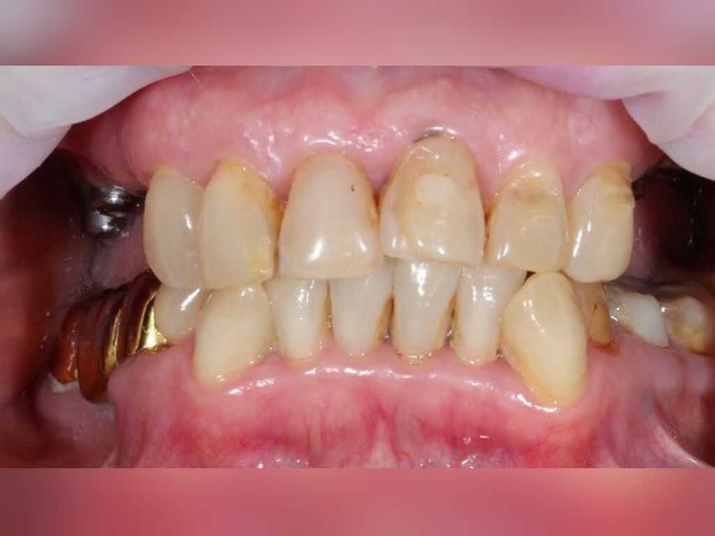 До имплантации 6