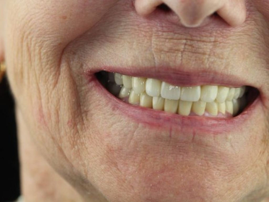 После имплантации 5