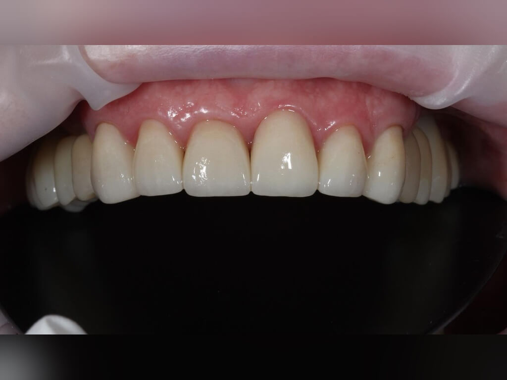 После имплантации 6