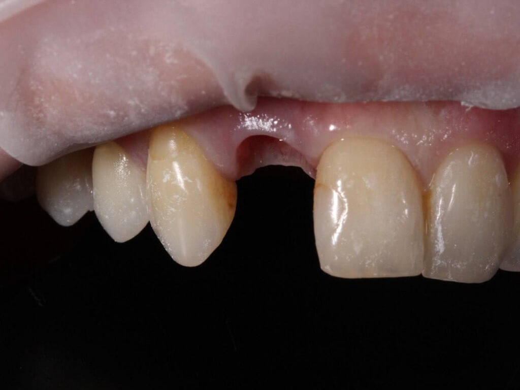 До имплантации 7