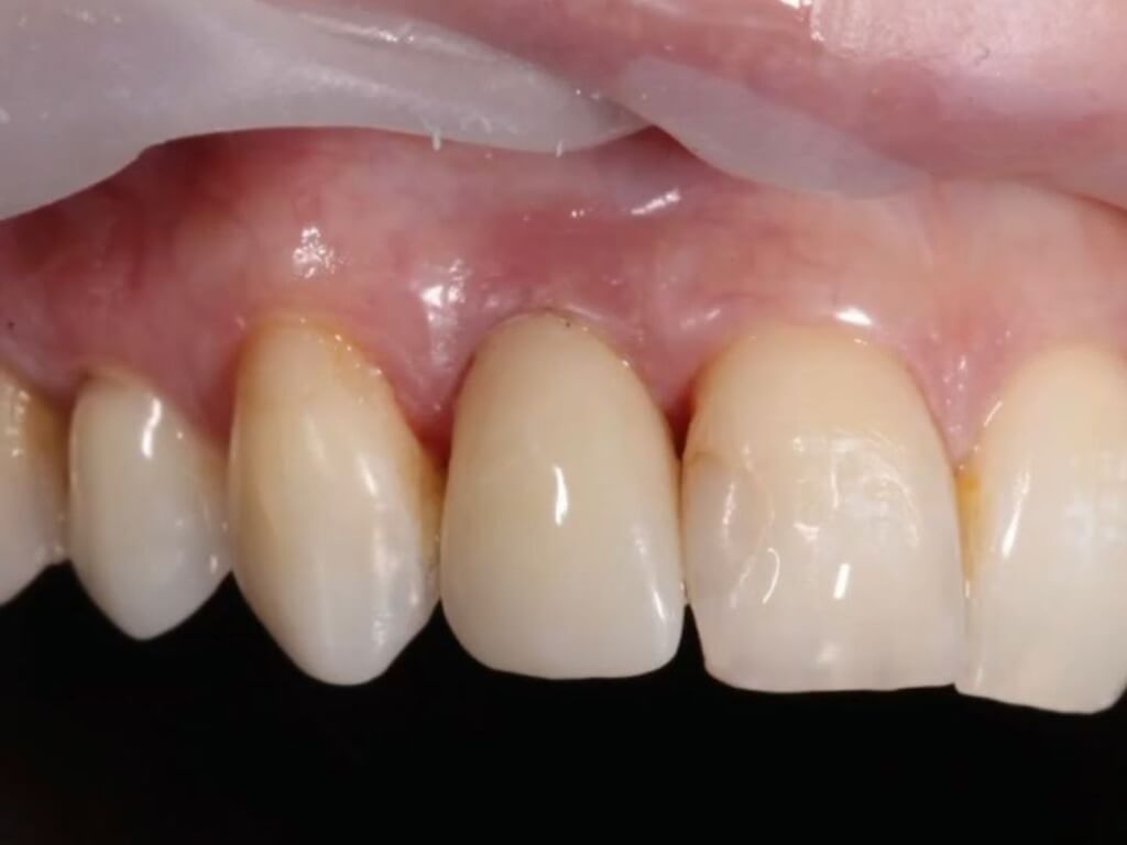 После имплантации 7